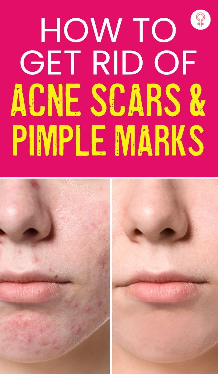 Glowing Again: How to Recover from Acne Spots and&nbsp;Scars